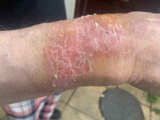 Any medical professionals? Advice on DH severe scald please