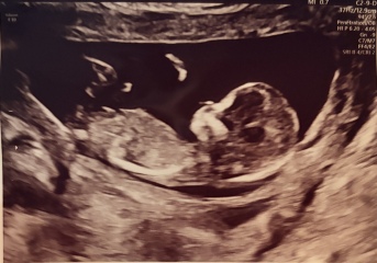Can anyone guess the baby’s gender from the 13 week nub scan?