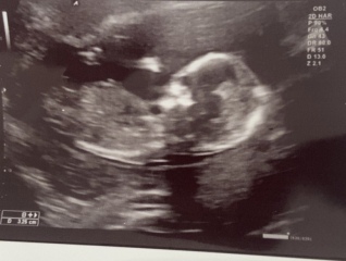15 week scan - guesses on skull theory or nub theory