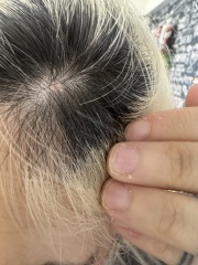 Small hard scalp lump for years, now worried after Googling