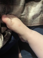 22 month is old bruising - Concerning?