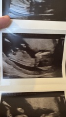 Did anyone have a boy nub on their 12 week scan but end up having a girl?