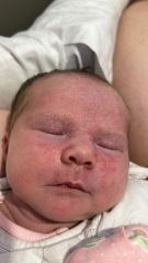 Rash that just won’t disappear, help?!