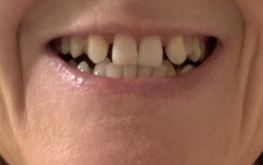 Invisalign help - share your happy endings?