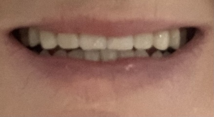 Invisalign help - share your happy endings?