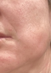 Botox for teeth grinding. How it’s going