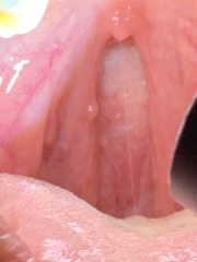 Slim coloured growth back of throat