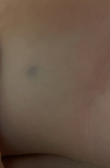 Little bruises in unusual spots - 1yr old.