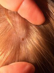 Moles on 11yr old’s scalp! Any dermatologists think this warrants a GP appointment??
