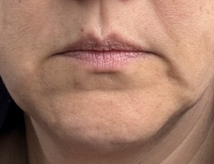 Marionette filler before and afters for those considering