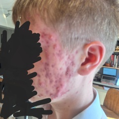 Teenage cystic acne out of control