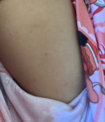 How do you confirm chickenpox?