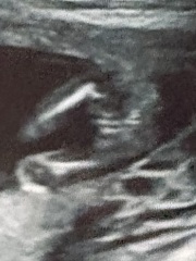Can you guess the baby's sex from my 15 week scan?