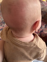 GP ignoring allergy concerns