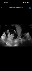 Told boy at 17-week scan but worried the sex may be wrong