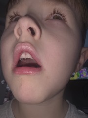 Do these look more like pimples or dribble rash?