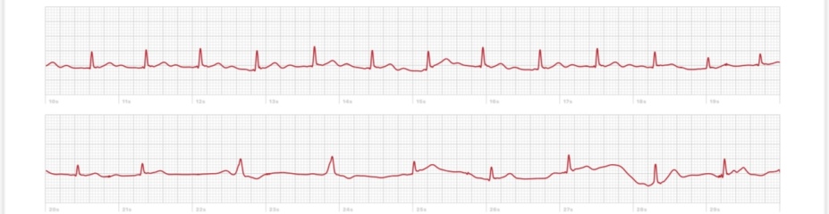 Is anyone able to take a quick look at a heart tracing?❤️