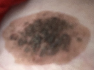 Does this mole look suspicious?