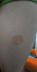 Discoid eczma?