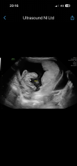 Incorrect gender at 17weeks