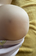 22 month is old bruising - Concerning?