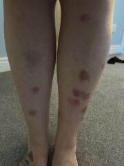 Any doctor or pharmacist - mosquito bites