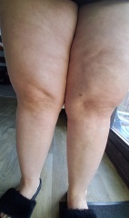Is this Edema??