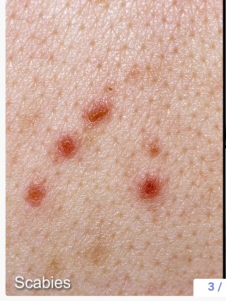Does this rash look like shingles or just an insect bite?