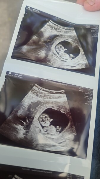 Any guesses on the nub from my pregnancy scan?
