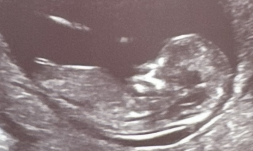 Girl or boy? 12 week 3 day scan