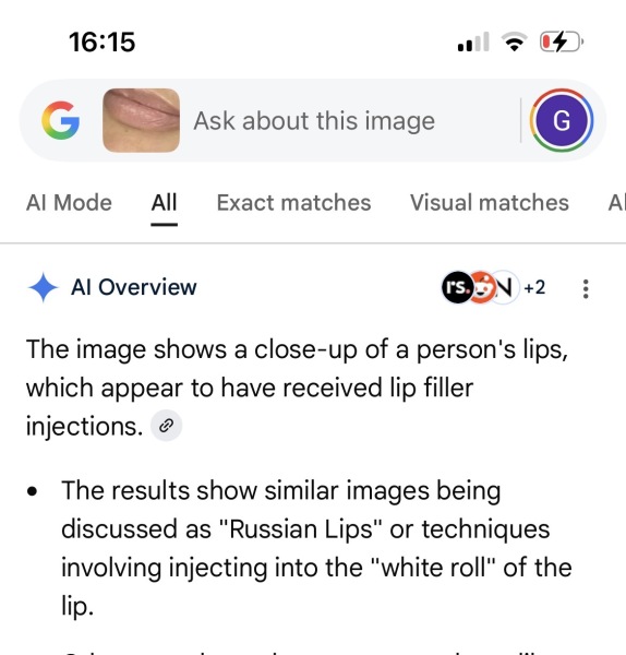 To ask if you had terrible embarrassing lip filler swelling