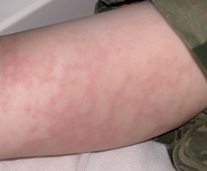 parvovirus