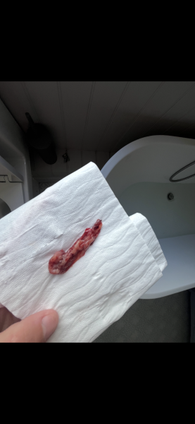 TW - sensitive photo. Miscarriage or clot?