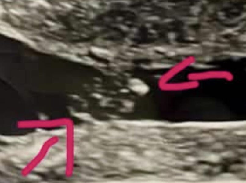 Possible twin pregnancy