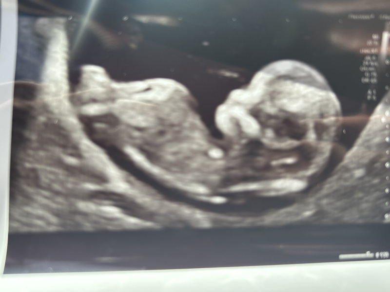 Pregnancy nub and skull theory guesses: boy or girl?