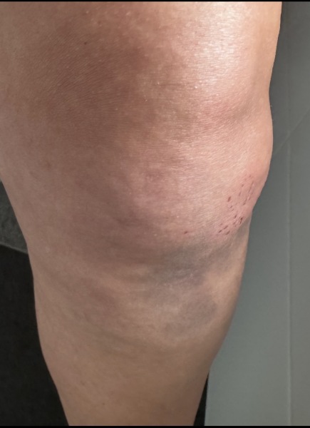 Advice to help the bruising go down pics included