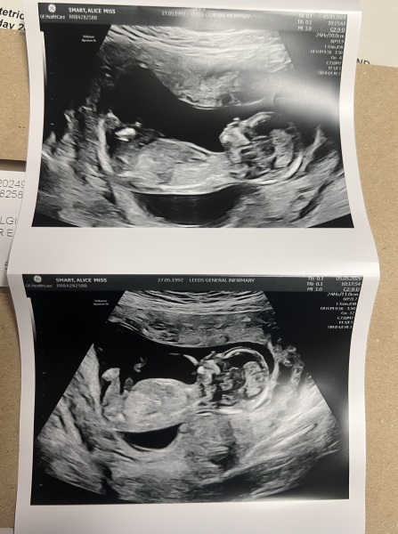 Any gender guesses from my 13 week ultrasound photos?