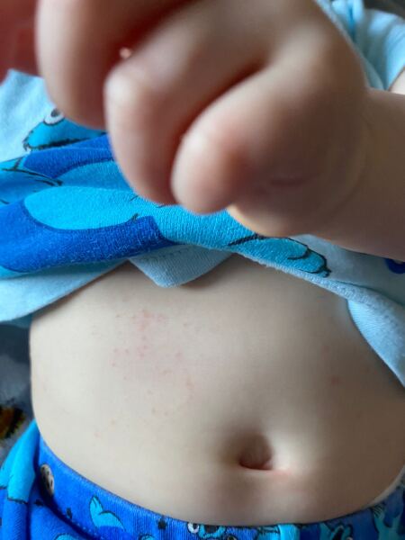 Rash on infant