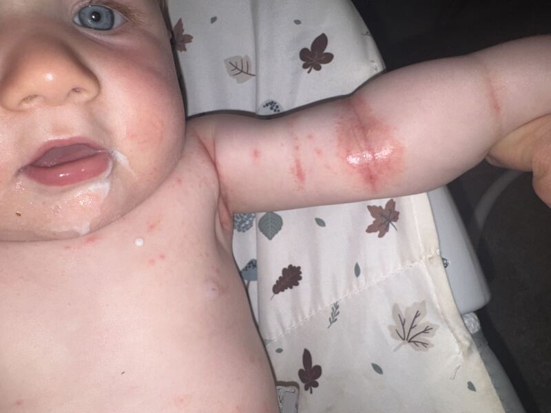 10 month old with a really bad rash! Any idea what it looks like/ could be and desperate for some home remedies.