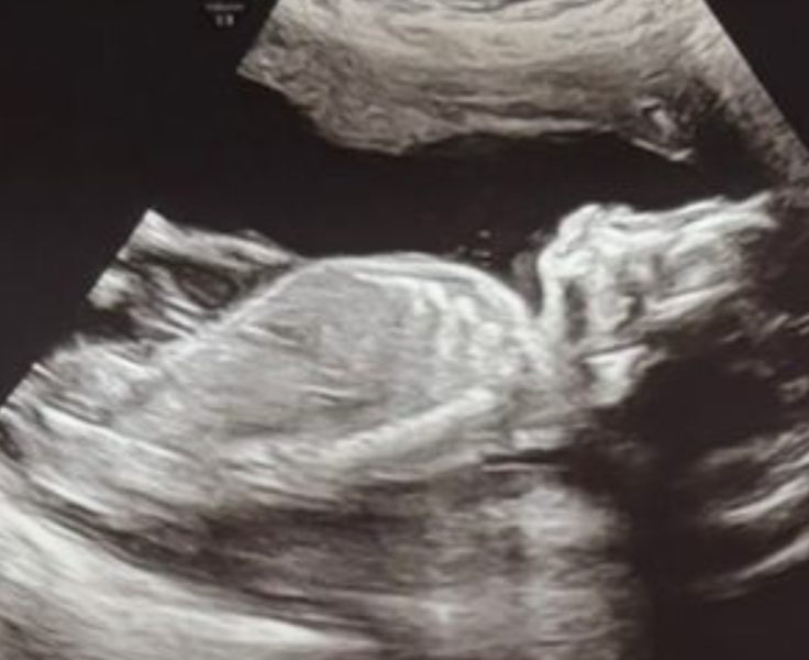 Changed my mind about finding out the baby's sex at the scan