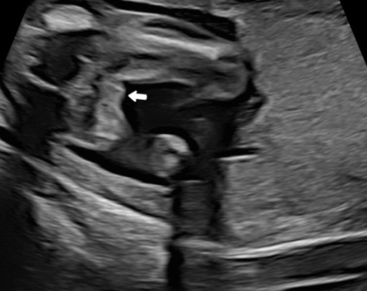 17 week potty shots. Confused. Please help!