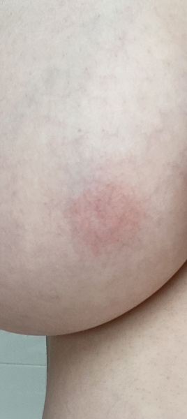 Rash on one breast