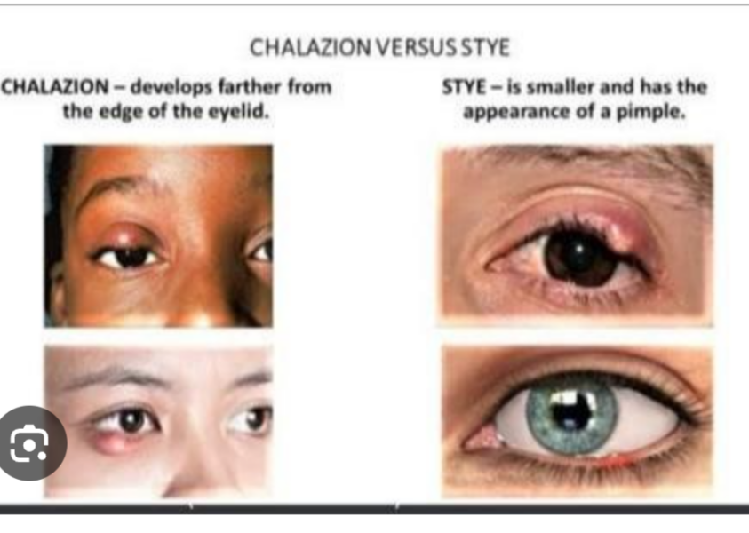 Is this a stye or a chalazion?  Back to pharmacist?