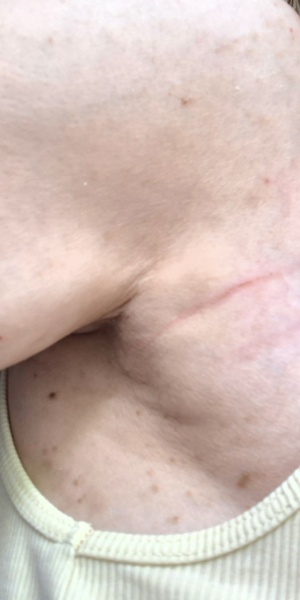 Extremely worried about this boob dimple