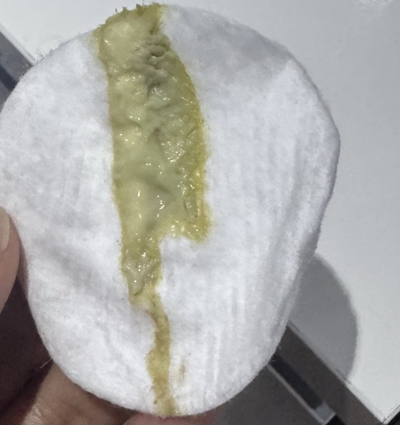 TMI- green discharge could it be UTI