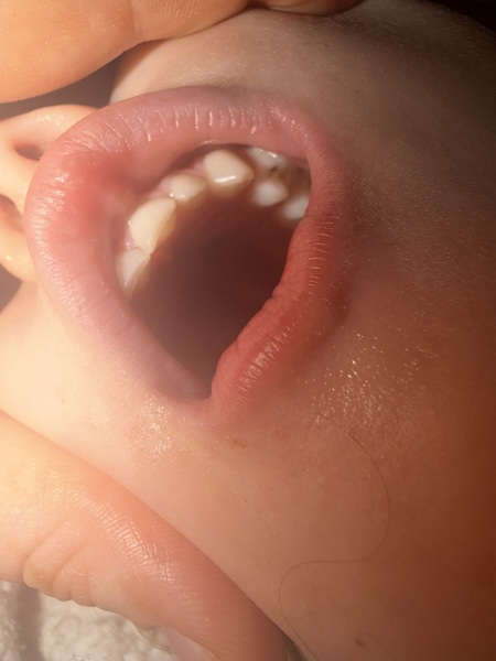 3.5 year olds teeth