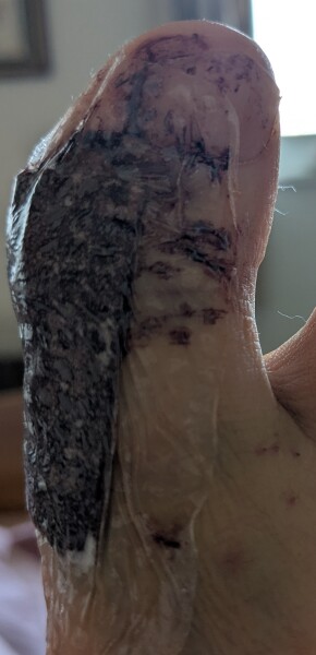 Should I change this dressing? Warning that photo is not pleasant!