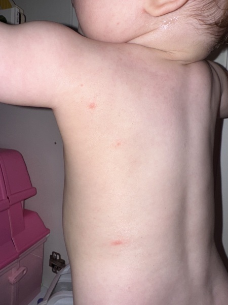 Baby rash