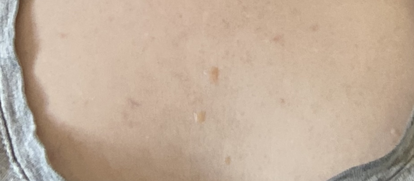 Flattish beige growths on chest - how to get rid?