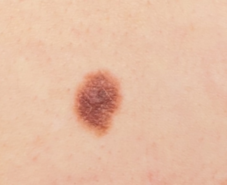 Mole help